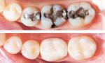 Comparison of metal and white fillings