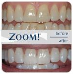 Zoom whitening before and after